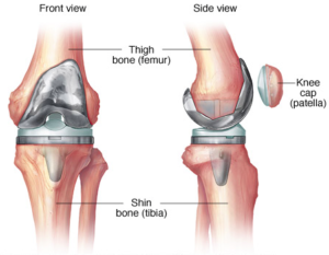 Front view and side view of a total knee replacement (image from Mayo Foundation for Medical Education and Research)