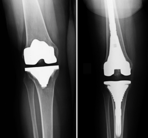 Before and after x-ray of a primary TKR (left) and revision TKR (right). Notice the revision components with longer stems. (image from the American Academy of Orthopaedic Surgeons)