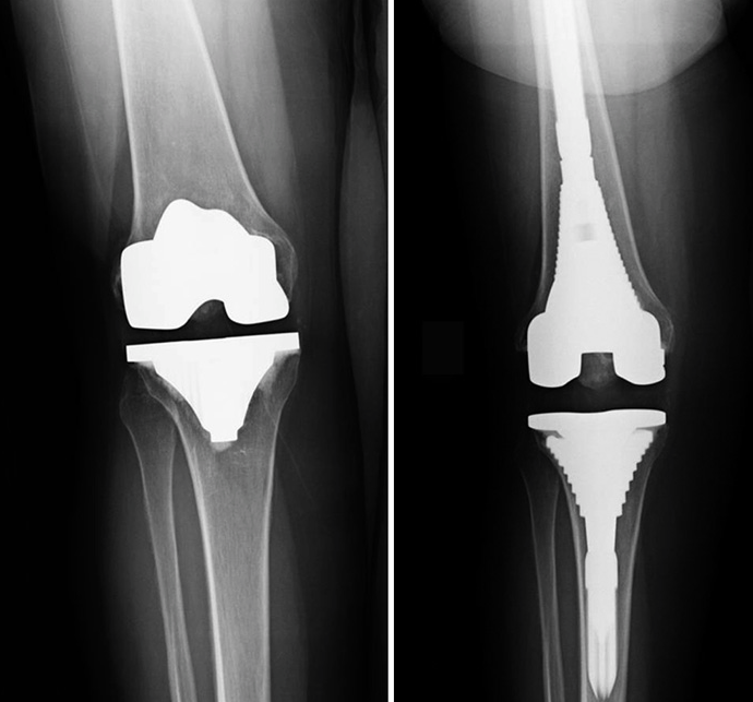 How can I tell if my partial knee replacement is failing?